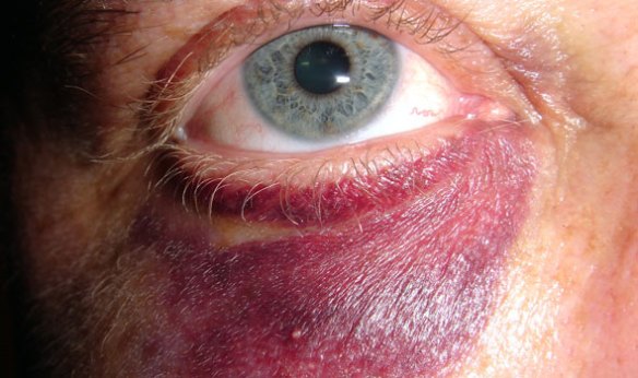 how-to-heal-a-black-eye how-to-heal-a-black-eye